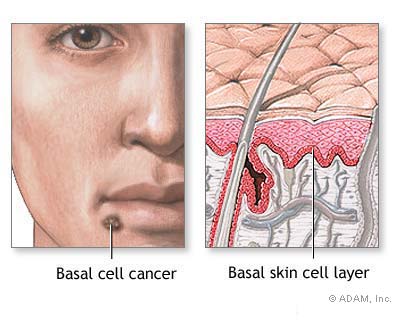 Basal Cell Carcinoma  سرطان الخلية القاعدية