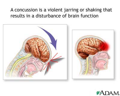 الارتجاج Concussion Concussion.jpg