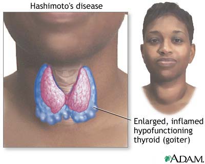 Hashimoto_disease_Thyroiditis.jpg