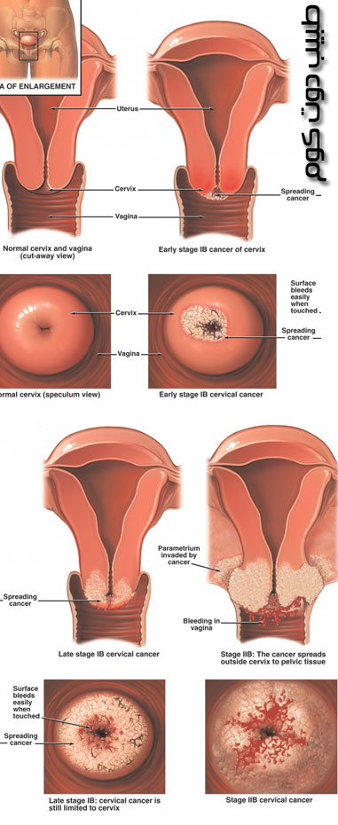 سرطان عنق الرحم Human Papilloma Virus HPV