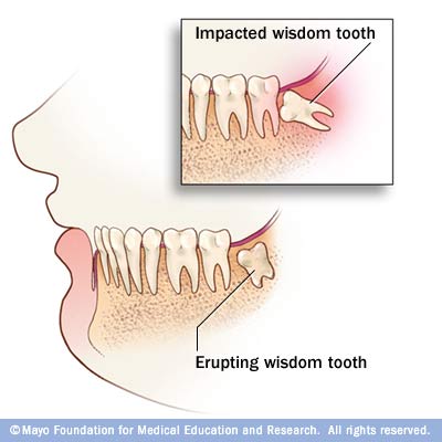 Impacted_wisdom_teeth.jpg