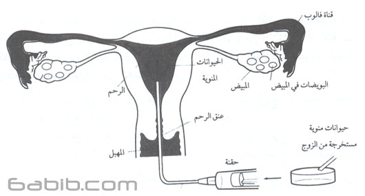       Artificial insemination Intrauterine insemination