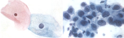 Normal and Abnormal Cervical Cells