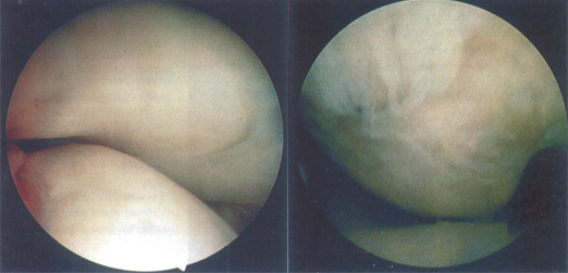 Normal Knee and Knee with Diseased Cartilage