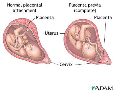 Placenta-Previa.jpg