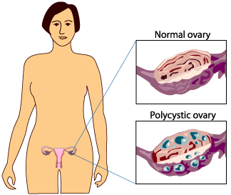 بروتوكول علاج تكيس المبيض Polycystic_Ovary_Syndrome.gif