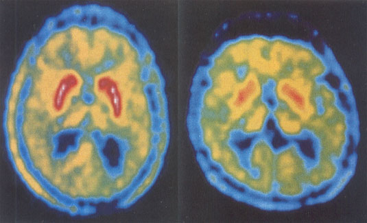 Positron Emission Tomograpy of normal beain and brain of a person
            with Parkinson disease