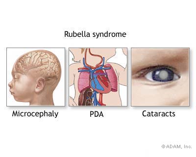 Rubella syndrome