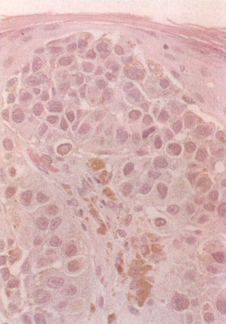 Skin Cancer Cells