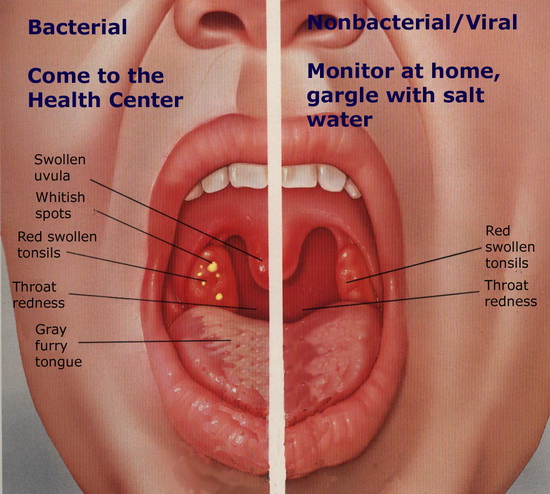 Tonsillitis التهاب اللوز