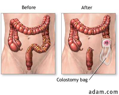 colostomy تفميم القولون