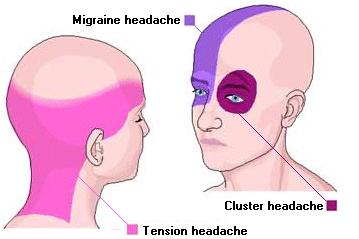 headache type انواع الصداع