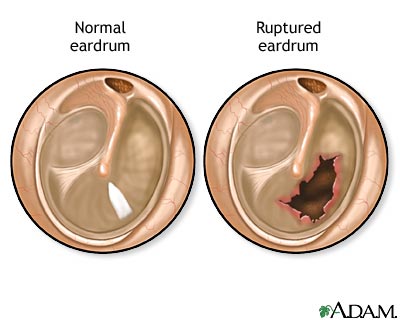 ruptured-eardrum.jpg