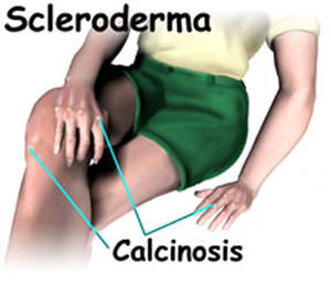 scleroderma_symptoms_1.jpg