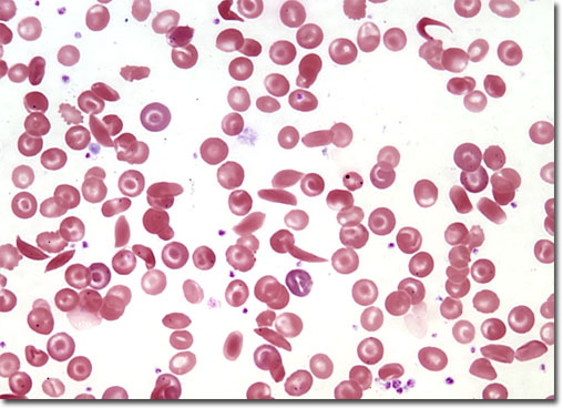 ‏أنيميا الخلايا المنجلية و سجية الخلايا المنجلية Sickle Cell Anemia