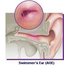 swimmers_ear.jpg