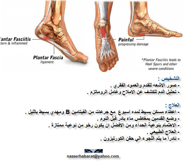 heel pain plantar_fasciitis2.j