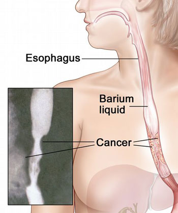 Barium swallow. The patient swallows barium liquid and it flows through the esophagus and into the stomach. X-rays are taken to look for abnormal areas.