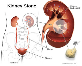 حصى الكلى – حصوة الكليه – الحصوه الكلويه Kidney Stones