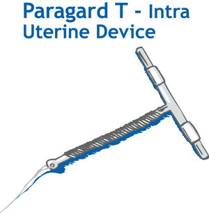       Intrauterine device ( IUD