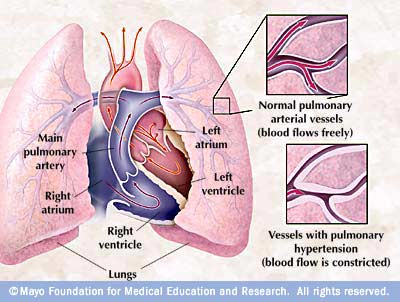 ارتفاع ضغط الدم الرئوي Pulmonary Hypertension