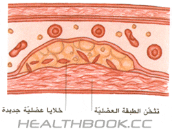   Atherosclerosis 9f4012106f.gif