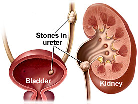 حصى الكلى – حصوات الكلية – الحصوة الكلوية Kidney Stones