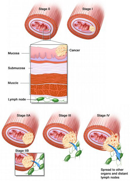 As esophageal cancer progresses from Stage 0 to Stage IV, the cancer cells grow through the layers of the esophagus wall and spread to lymph nodes and other organs